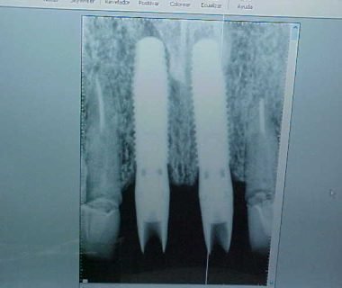 caso clinico dental hesire (12)