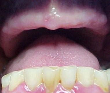 caso clinico dental hesire (2)