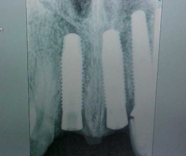 caso clinico dental hesire (8)